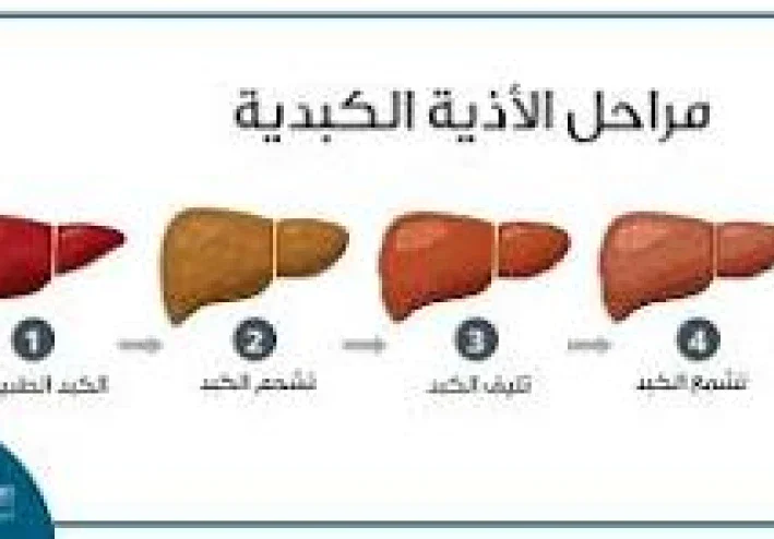 عندما يتقدم التليف