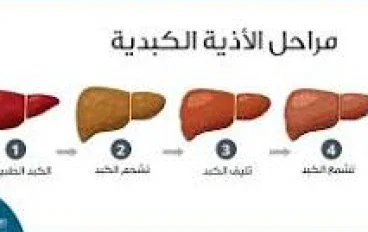 عندما يتقدم التليف