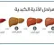 صورة مقال عندما يتقدم التليف