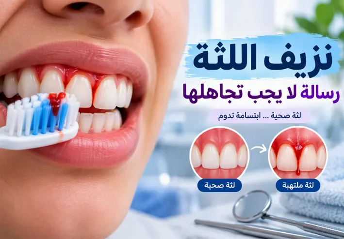 نزيف اللثة عند التنظيف: ماذا يعني تكراره، وكيف تُشخَّص أمراض اللثة وتُعالَج؟