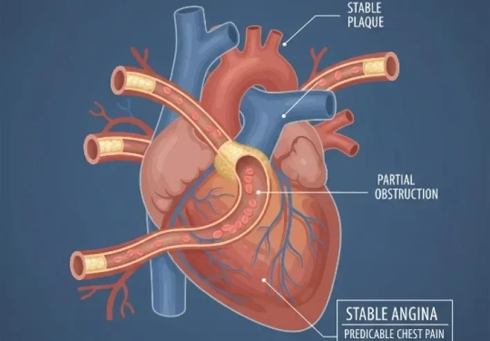 Coronary Artery Disease: How It Develops and Its Symptoms