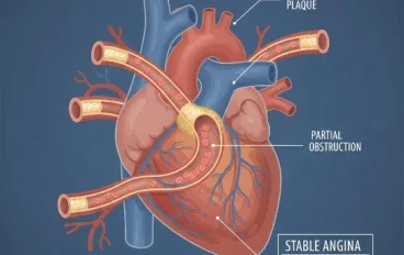 Coronary Artery Disease: How It Develops and Its Symptoms