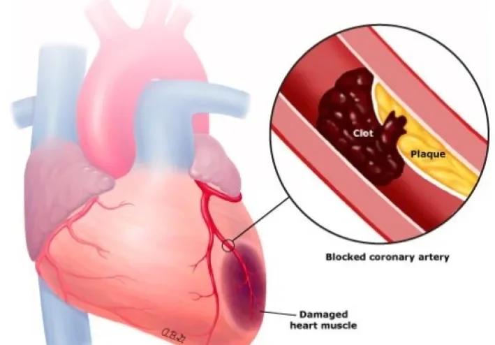 Heart Attack: Symptoms, Causes, and When It Becomes an Emergency