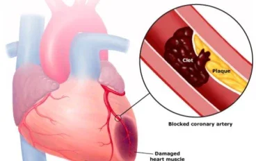 Heart Attack: Symptoms, Causes, and When It Becomes an Emergency