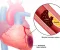 Heart Attack: Symptoms, Causes, and When It Becomes an Emergency
