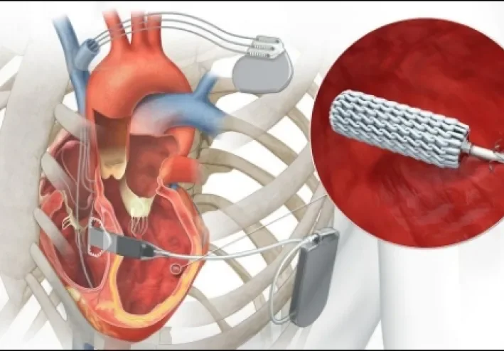 Can Heart Deterioration Be Halted Before Reaching a Critical Stage? What Modern Treatments Say