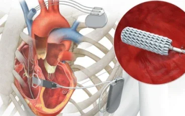 Can Heart Deterioration Be Halted Before Reaching a Critical Stage? What Modern Treatments Say