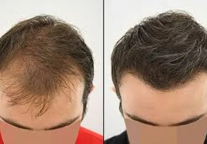 الجديد في تقنيات زراعة الشعر