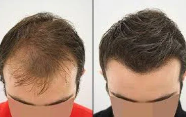 الجديد في تقنيات زراعة الشعر