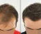 الجديد في تقنيات زراعة الشعر