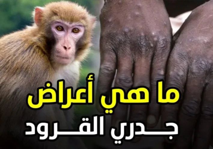 جدري القردة: كل ما تحتاج تعرفه عن أعراضه، أسبابه، وطرق الوقاية