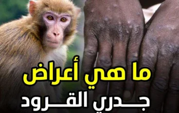 جدري القردة: كل ما تحتاج تعرفه عن أعراضه، أسبابه، وطرق الوقاية