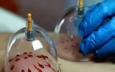 الحجامة الدواء العجيب 