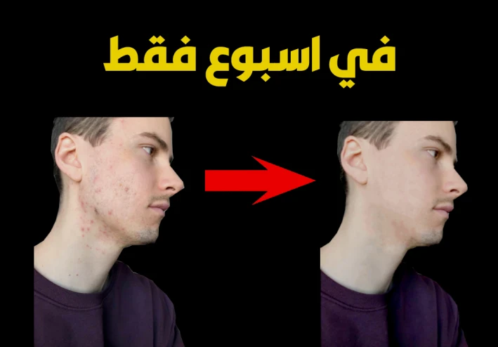 4 طرق سحرية للتخلص من حب الشباب عند الرجال في اسبوع واحد فقط