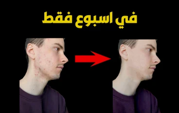 4 طرق سحرية للتخلص من حب الشباب عند الرجال في اسبوع واحد فقط